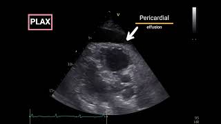 Pericardial Effusion with Doppler Echocardiographic criteria for Tamponade [upl. by Jody]