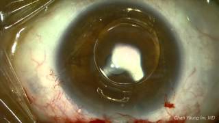 Cataract surgery in phakic IOL eye Part 1 ARTIFLEX [upl. by Annekahs513]