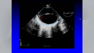 Multimodality Imaging of Diseases of the Thoracic Aorta in Adults [upl. by Eellek]