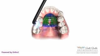 Pendex  Orthodontic Appliance [upl. by Sokcin]