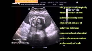 CASE 95 20 WK FETAL HYDROPS ULTRASOUND [upl. by Fairman203]