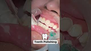 Step By Step Teeth Polishing  Smile Designing  Happy Smiles dental Care  shorts [upl. by Hugh]