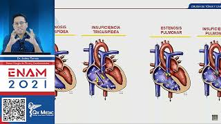 Estenosis E Insuficiencia Válvula Tricúspide y Pulmonar [upl. by Deborath]