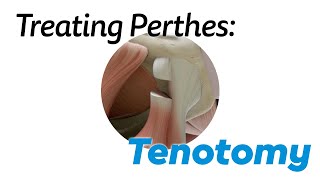 Tenotomy for Treating Perthes Disease in Children [upl. by Iznil220]