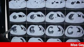 Polytrauma II Hemopneumothorax X Ray of Pt II What is Hemothorax II Lung injury I DR Yogendra Sahu [upl. by February675]