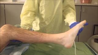 Ankle clonus [upl. by Reube]