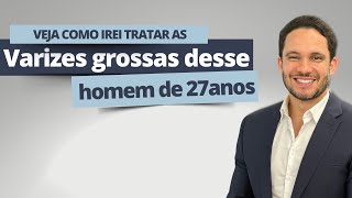 Veja como irei tratar varizes grossas desse homem de 27 anos [upl. by Nref]