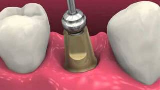 Restoring BioHorizons Dental Implants 2011 [upl. by Urbas358]