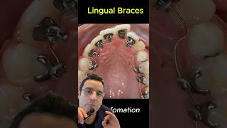 Orthodontie linguale  comment allier efficacité et discrétion [upl. by Aliak433]