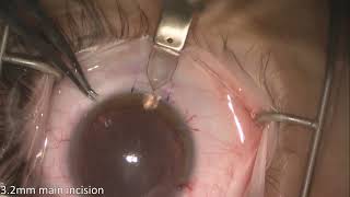 Implantation of EVO Visian ICL [upl. by Adnil976]