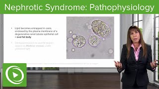 Nephrotic Syndrome Pathophysiology with Case– Nephrology  Lecturio [upl. by Sefton]