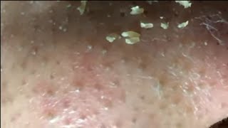 cabut komedo  asmr acne [upl. by Aoniak]