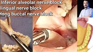 Local Anesthesia Inferior Alveolar Nerve block amp long buccal Nerves block Mandibular nerve block [upl. by Roldan]