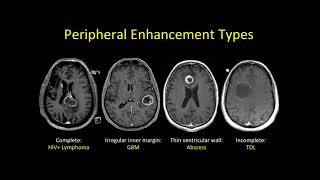 imaging of Multiple sclerosis [upl. by Gunther30]