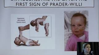 Diagnosing PraderWilli Syndrome [upl. by Nitsur]