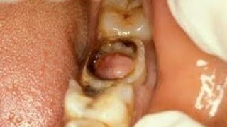 Pulp Poly  Chronic Hyperplastic Pulpitis  Dentalks [upl. by Tunk]