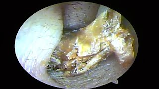 Remove two large cerumen plugs and dry fungus pieces from the ears and clean them（20241025） [upl. by Naehs]