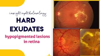 HARD EXUDATES  Hypopigmented lesions of the retina [upl. by Buchalter]