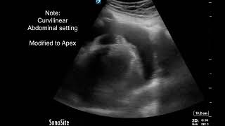 POCUS guided Pericardiocentesis An Intuitive Approach [upl. by Eboh223]