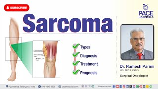 Sarcoma Cancer  Types Diagnosis Treatment amp Prognosis  sarcomatreatment [upl. by Sucul496]