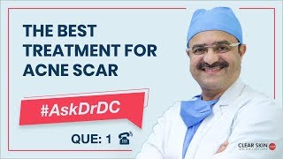 Which is the best treatment for acne scarsमुँहासे निशान के लिए इलाज  AskDrDc Que1  In HINDI [upl. by Wehner]