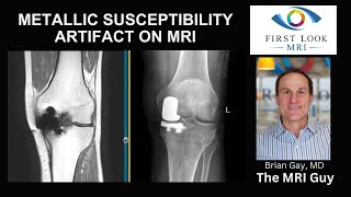 Metallic susceptibility artifact on MRI [upl. by Vernon311]