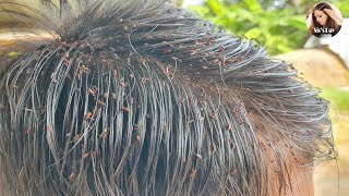 Chill video to watch head lice removal 56 [upl. by Hanonew]