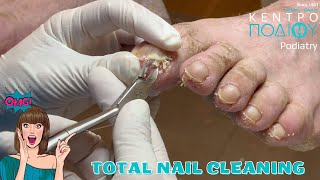 Total Nail Cleaning feet toe κεντροποδιου foot podologos calluses podiatrist corn footcare [upl. by Niram928]