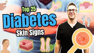 What are the symptoms of type 2 diabetes Early Skin Signs [upl. by Pathe]