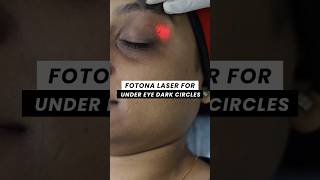 Fotona Laser for Under eye Dark Circles  ClearSkin Pune [upl. by Clifford672]