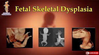 Fetal Skeletal Dysplasia [upl. by Krock]