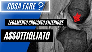 Legamento crociato anteriore assottigliato 🟠  Cosa Significa❓ [upl. by Mauri904]