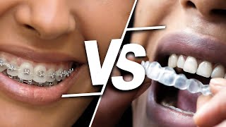 Which is best BRACES or INVISALIGN Clear Aligner [upl. by Tinor108]