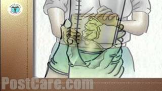 Discharge Emptying a Urinary Drainage Bag MiniFree Patient Education Medical Video [upl. by Shanks]