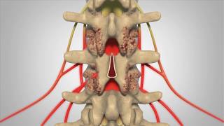 Laminectomy  Patient Education [upl. by Violetta769]