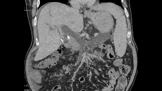 Portal  splenic  superior mesenteric vein thrombosis extensive  CT [upl. by Adnoval]