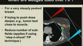 Basics of Breast Cancer Radiotherapy Treatment Planning [upl. by Crellen]