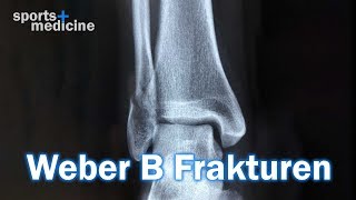 Funktionelle Behandlung bei Weber BFraktur [upl. by Altheta143]