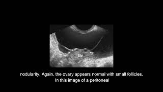 Sonographic Evaluation of The Ovary and Adnexa [upl. by Batish777]