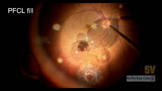 The Craft of Retinal Autograft [upl. by Nnylyam]