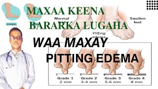 PITTING EDEMA  MAXAA KEENA BARARKA LUGAHA SIDA LOO DAAWEEYO [upl. by Leonelle]