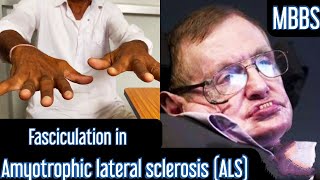 Fasciculation in Amyotrophic lateral sclerosis ALS mbbs medicine neet usmle aiims next [upl. by Ykcin]