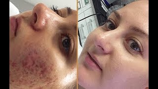 Tretin 0025 For Remove Pimple Holes and Pimples Black Marks Review Hindi [upl. by Lebezej]