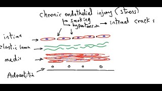 Systemic pathology 10  CVS  atherosclerosis  DRSAMEH GHAZY [upl. by Assen]