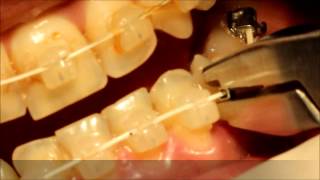 crimpable hook application and class III orthodontic elastics by Dr Amr Asker [upl. by Nikolaus]