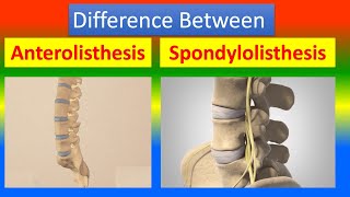 Distinction Between Anterolisthesis and Spondylolisthesis [upl. by Doug768]