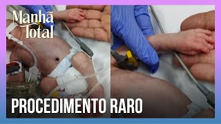 PROCEDIMENTO RARO Bebê prematuro passou por cirurgia do coração  MANHÃ TOTAL [upl. by Tnek480]