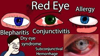 Red Eye Causes Symptoms and Treatment Pink eye causes [upl. by Juna319]