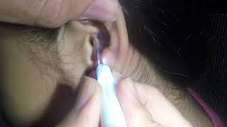 Girls Easy Earwax Removal [upl. by Eniliuqcaj425]