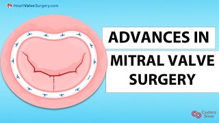 Mitral Valve Surgery Advances in MinimallyInvasive amp Transcatheter Procedures with Dr Chikwe [upl. by Amersham]